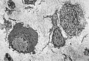 M,14y. | plasmocytoma - nasal cavity, plasmocyte and mastocyte M,14y. | plasmocytoma - nasal cavity, plasmocyte and mastocyte